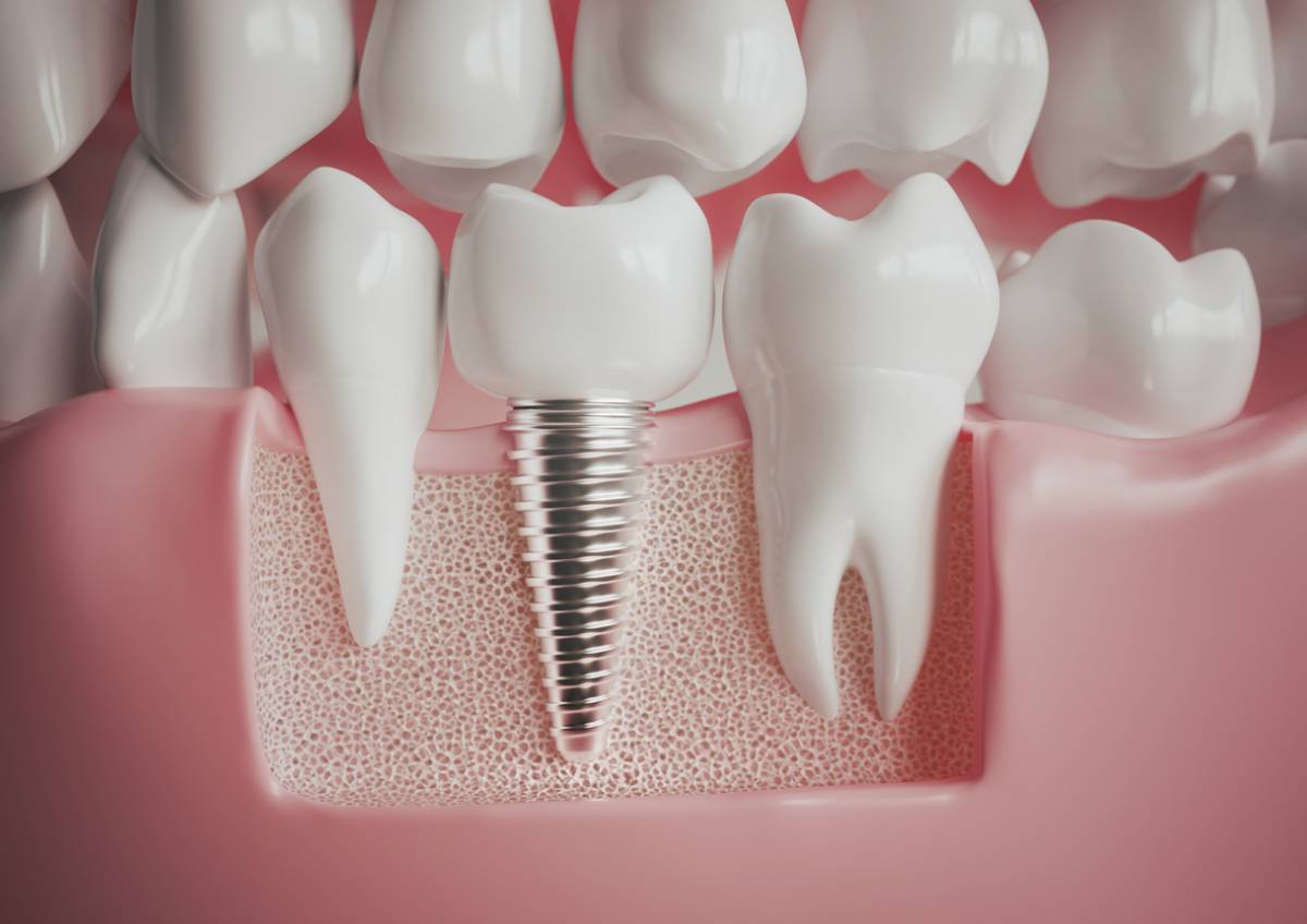 featured image for 4 tips for how to floss around dental implants