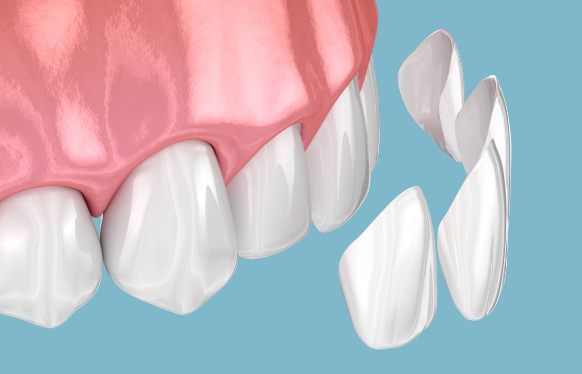 featured image for why are porcelain veneers so popular