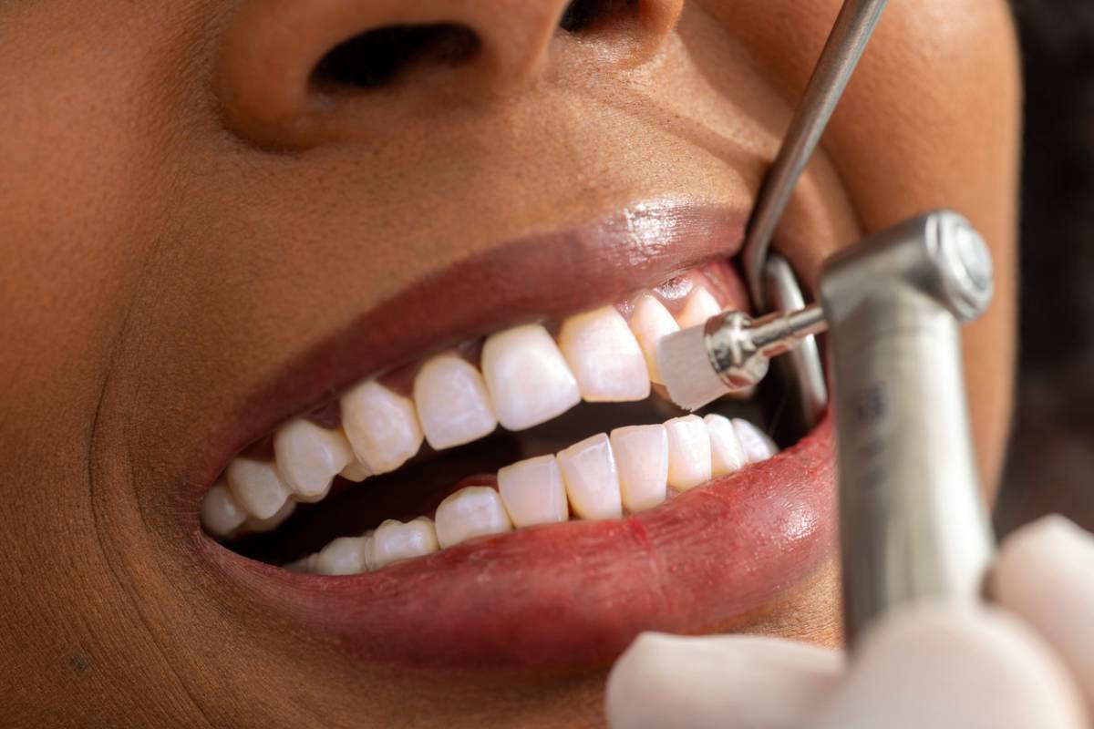 featured image for blog on how do you get rid of white spot lesions on your teeth