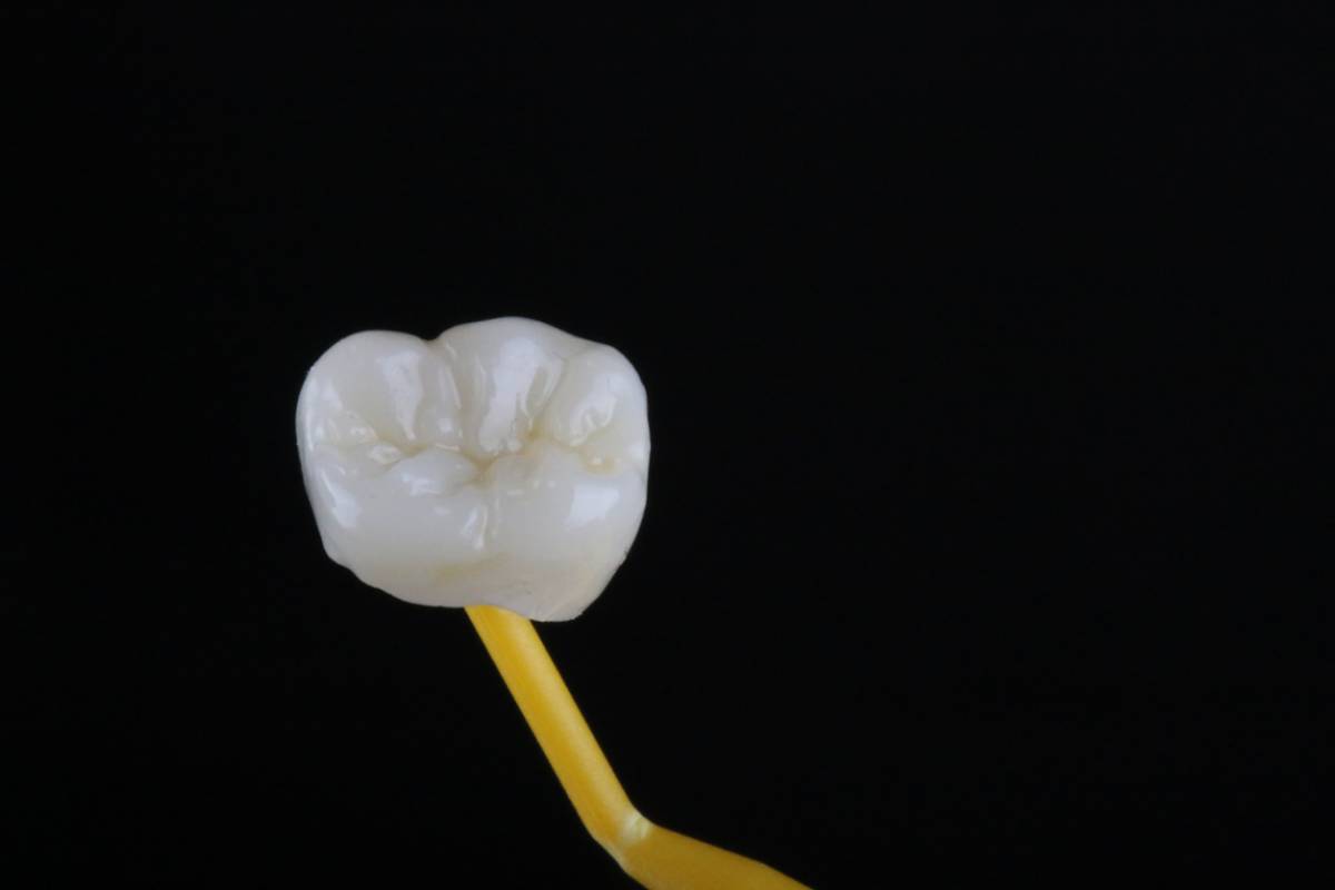 allergic reaction to dental crowns blog image